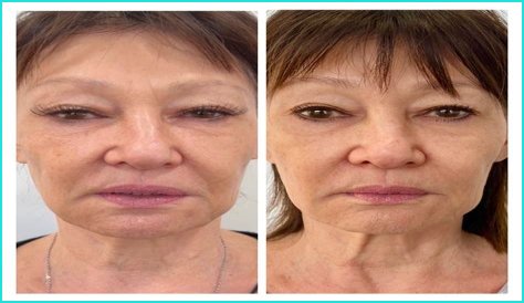 Has Marie Osmond Done Facelift And Plastic Surgery? Before And After Pics, Age And Height